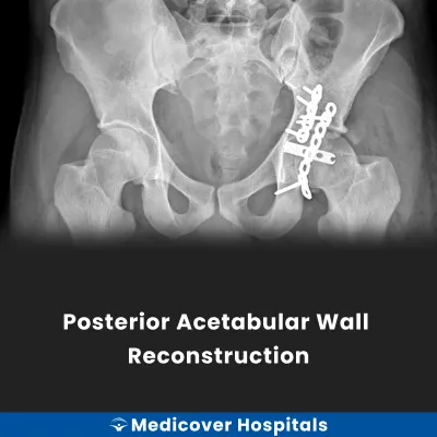 Posterior Acetabular Wall Reconstruction