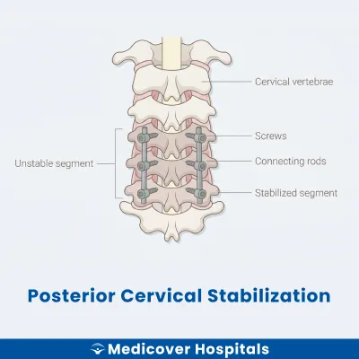Posterior Cervical Stabilization