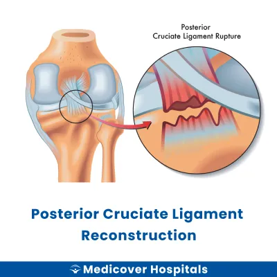Posterior Cruciate Ligament Reconstruction