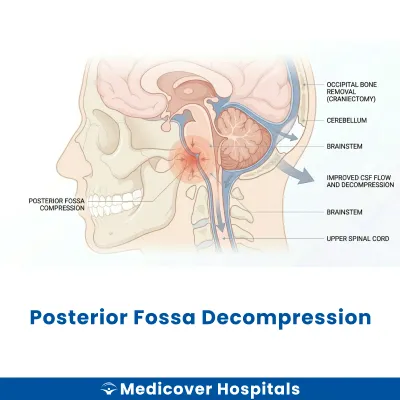 Posterior Fossa Decompression