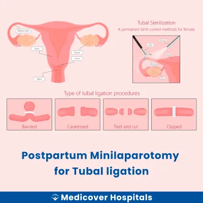 Postpartum Minilaparotomy for Tubal Ligation