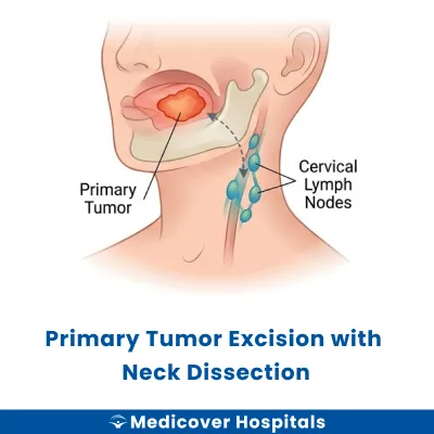 Primary Tumor Excision With Neck Dissection