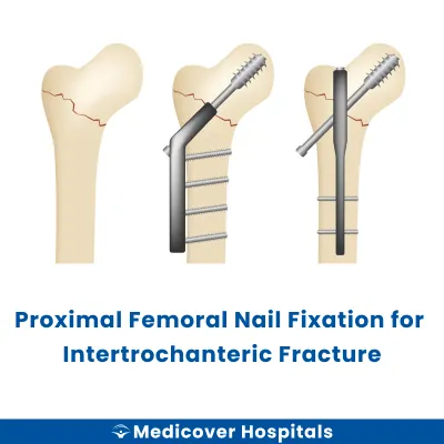 Proximal Femoral Nail Fixation for Intertrochanteric Fracture