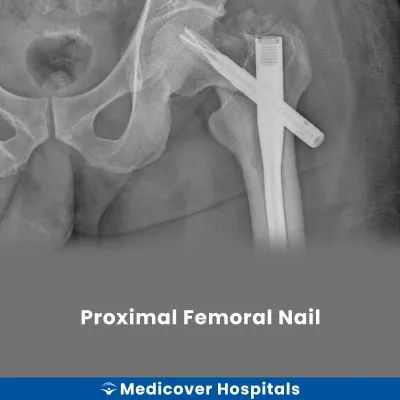 Proximal Femoral Nail