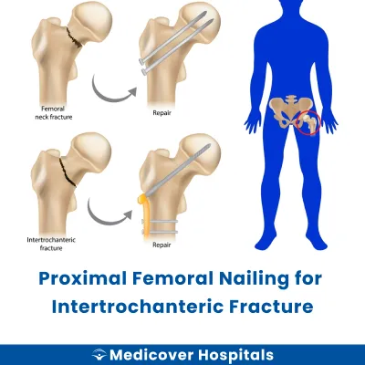 Proximal Femoral Nailing for Intertrochanteric Fracture