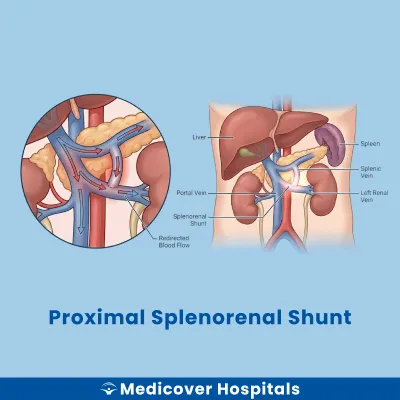 Proximal Splenorenal Shunt