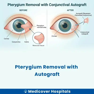 Pterygium Removal With Autograft