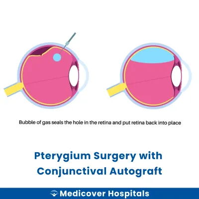 Pterygium Surgery With Conjunctival Autograft