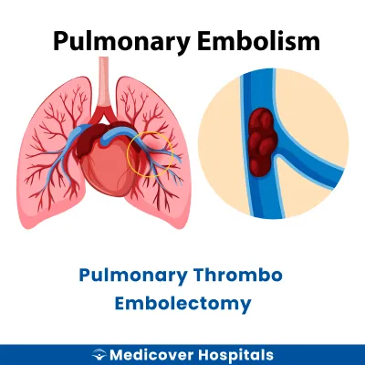 Pulmonary Thrombo Embolectomy