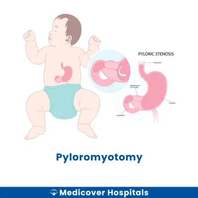 Pyloromyotomy