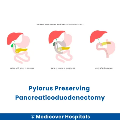 Pylorus Preserving Pancreaticoduodenectomy