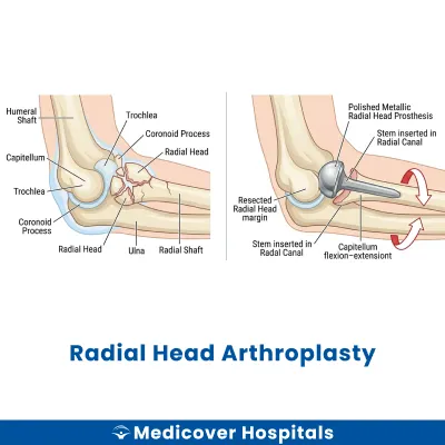 Radial Head Arthroplasty