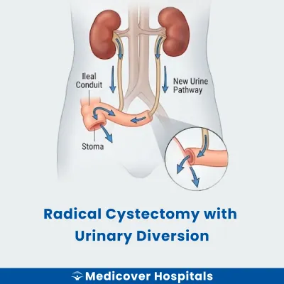 Radical Cystectomy With Urinary Diversion