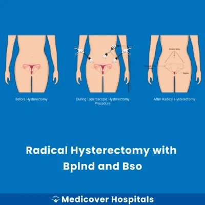 Radical Hysterectomy With Bplnd and Bso