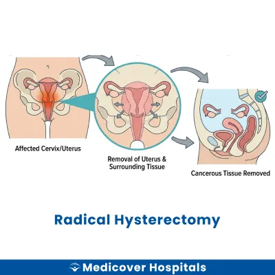 Radical Hysterectomy