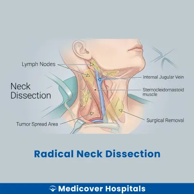 Radical Neck Dissection