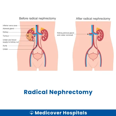 Radical Nephrectomy