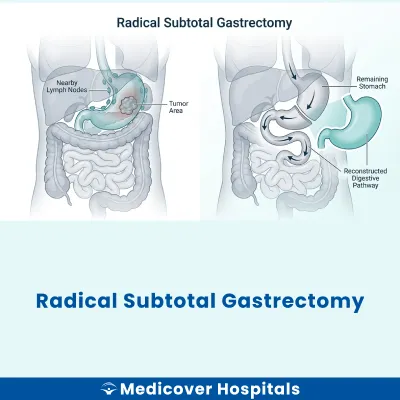 Radical Subtotal Gastrectomy