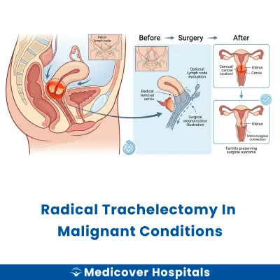 Radical Trachelectomy In Malignant Conditions