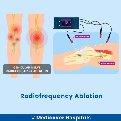 Radiofrequency Ablation