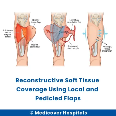 Reconstructive Soft Tissue Coverage Using Local and Pedicled Flaps