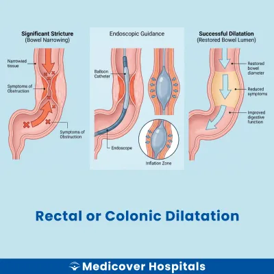 Rectal Or Colonic Dilatation