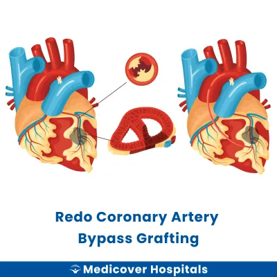 Redo Coronary Artery Bypass Grafting
