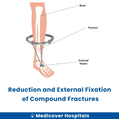 Reduction and External Fixation of Compound Fractures