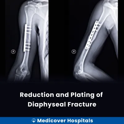 Reduction and Plating of Diaphyseal Fracture