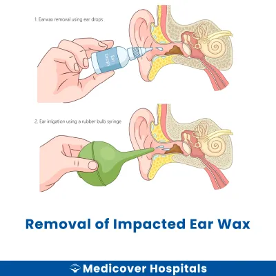 Removal of Impacted Ear Wax