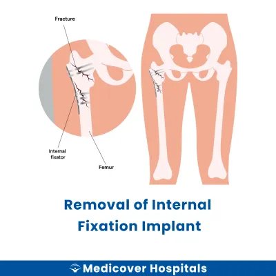 Removal of Internal Fixation Implant