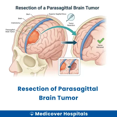 Resection of Parasagittal Brain Tumor