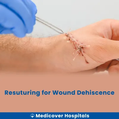 Resuturing for Wound Dehiscence