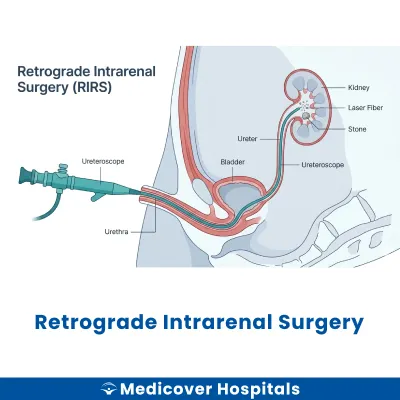 Retrograde Intrarenal Surgery