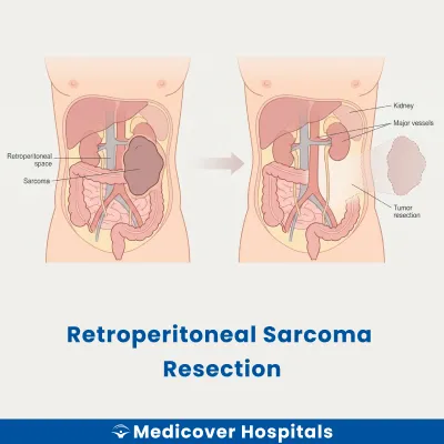 Retroperitoneal Sarcoma Resection