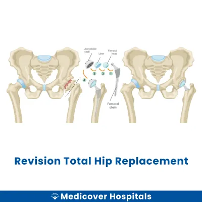 Revision Total Hip Replacement