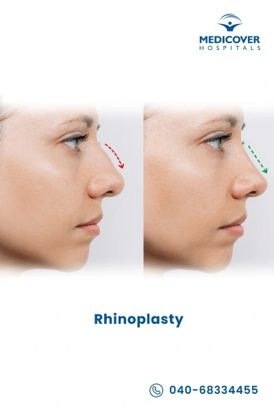 rhinoplasty