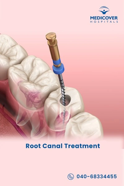 root-canal