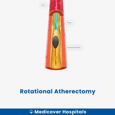 Rotational Atherectomy