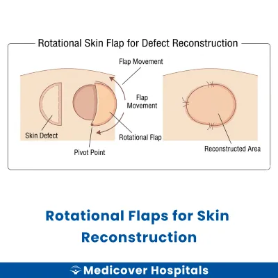 Rotational Flaps for Skin Reconstruction