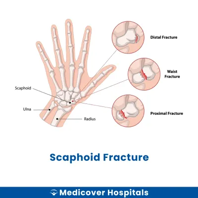 Scaphoid Fracture