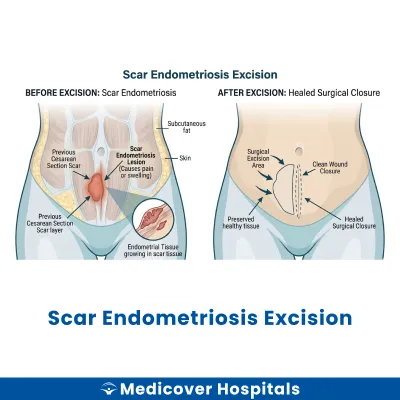 Scar Endometriosis Excision