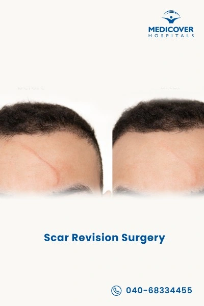 scar-revision