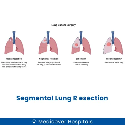 Segmental Lung Resection