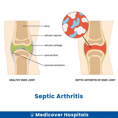 Septic Arthritis