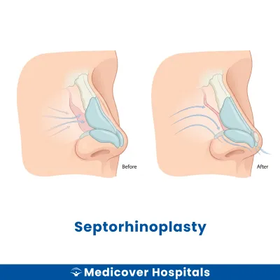Septorhinoplasty