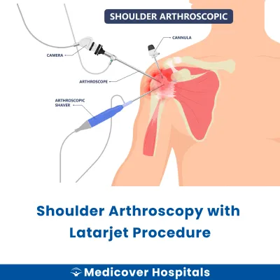 Shoulder Arthroscopy With Latarjet Procedure