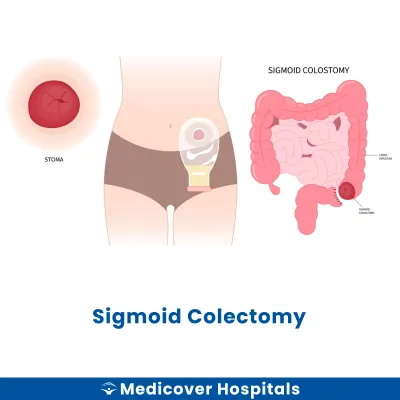 Sigmoid Colectomy