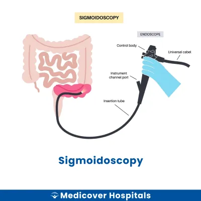 Sigmoidoscopy