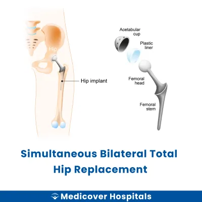 Simultaneous Bilateral Total Hip Replacement